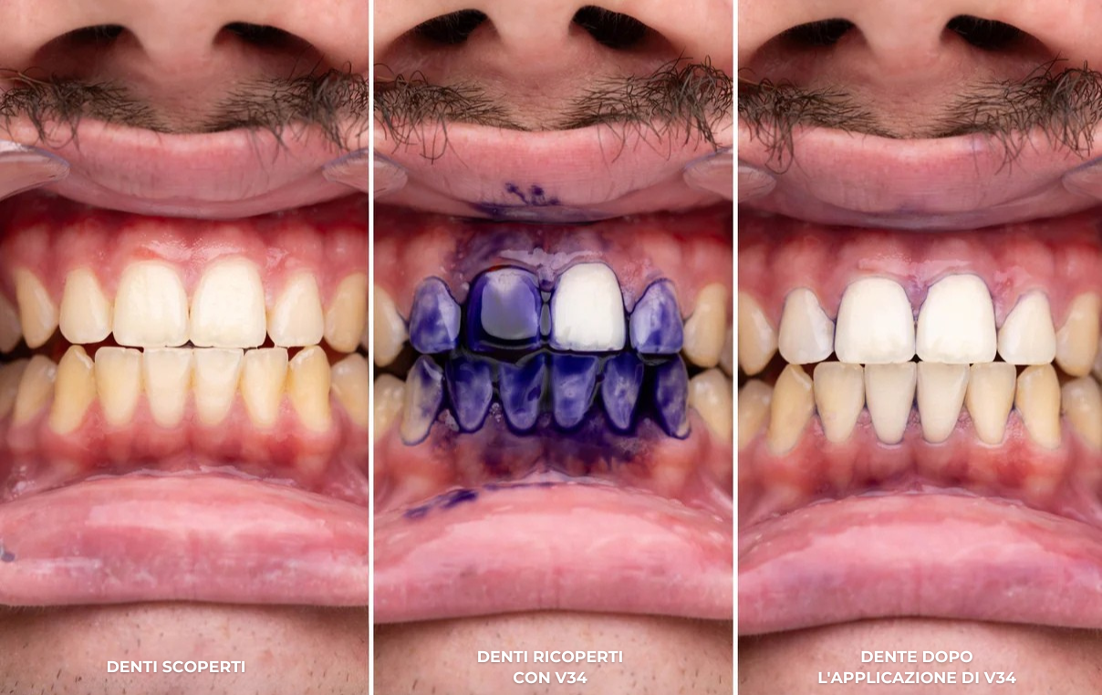 Siero correttore del colore V34 - Siero dentale