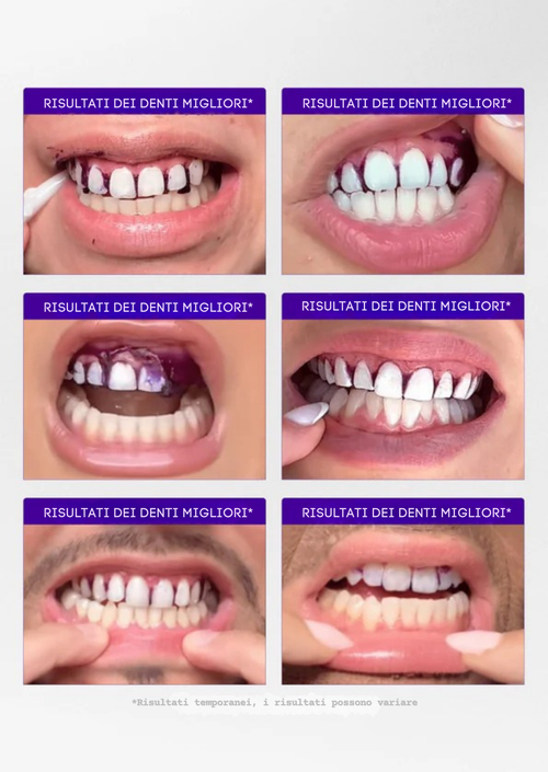 Bundle Sbiancante Completo